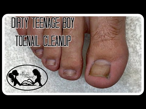 Halamang-singaw sa iyong mga paa sa bahay Para sa paggamot ng kuko soryasis cream