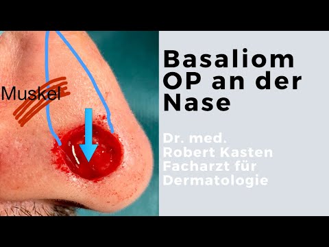 Basaliom an der Nase: OP-Ergebnisse, Lappenplastik, Hauttransplantation