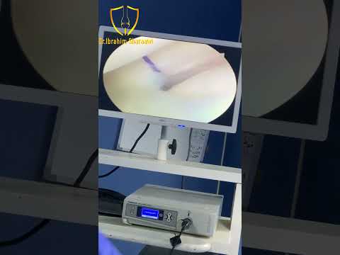 خطوات عملية اعادة بناء الرباط الصليبي الامامي