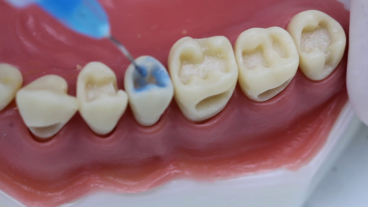 Sistema Adesivo Convencional de 3 Passos