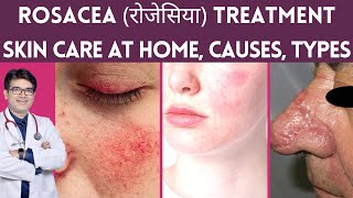 Rosacea Treatment, Skin Care, Laser Treatment | Rosacea का इलाज | Rosacea Causes, Types | Hindi