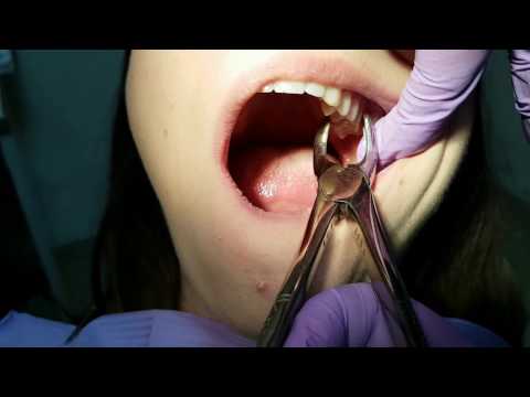 Tooth extraction - how to use dental forceps- shown on a pat...