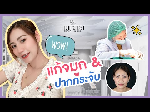 หน้ามีมิติ ดูหวานละมุน จนใครๆก็ทักว่าสวยขึ้น ด้วยการแก้จมูก & ปากกระจับ ที่ นารดาคลินิก หน้ามีมิติ ดูหวานละมุน จนใครๆก็ทักว่าสวยขึ้น ด้วยการแก้จมูก & ปากกระจับ ที่ นารดาคลินิก