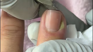 Ep_8653 Fingernails skin removal 👣 นิ้วนี้..เคยเล็บหลุดครับ 🙂 (clip from Thailand)