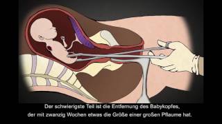 Chirurgische Abtreibung im 2. Trimester