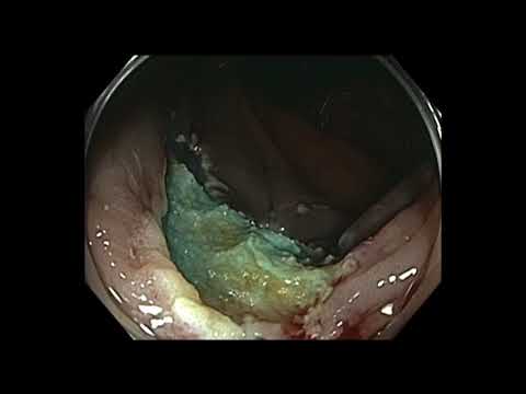 Colonoscopy: Ascending Colon EMR - Large Polyp