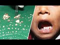 Doctors Remove Over 500 Teeth From Boy's Mouth