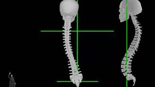 Fibromyalgia and Cancer - Curvature Pattern