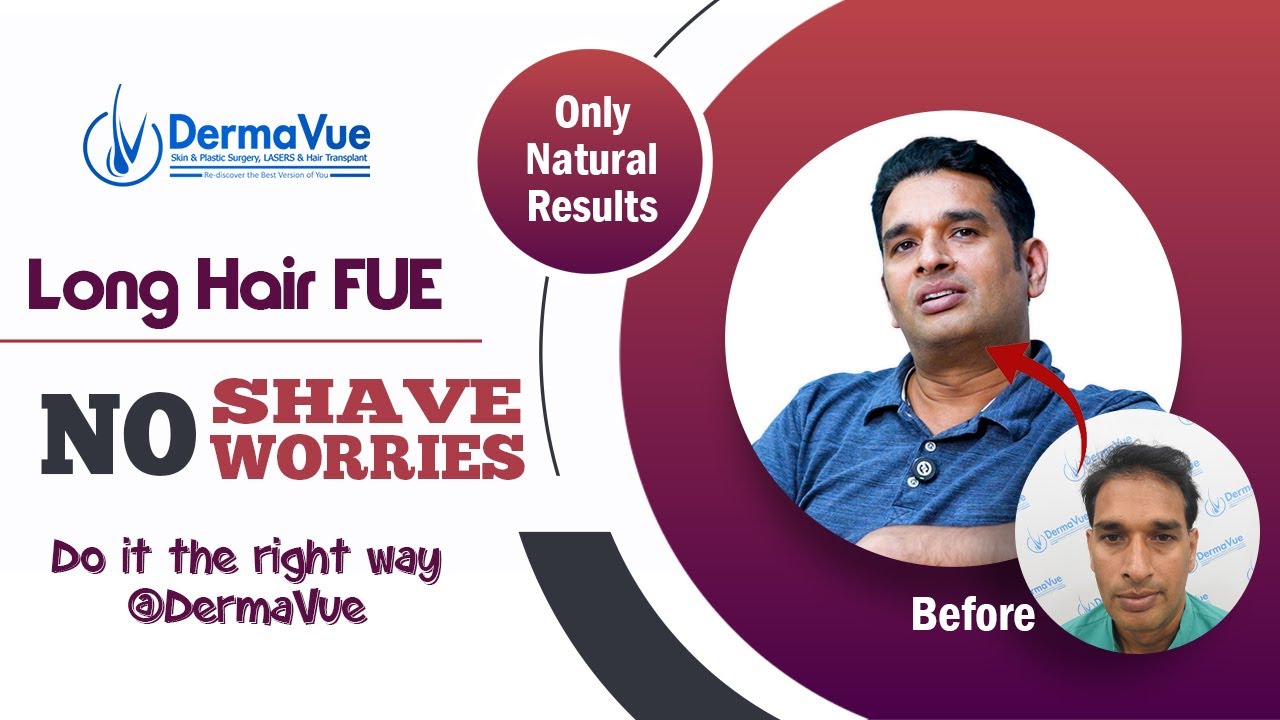 Hair Transplant Results — 9 Months After SMART FUE