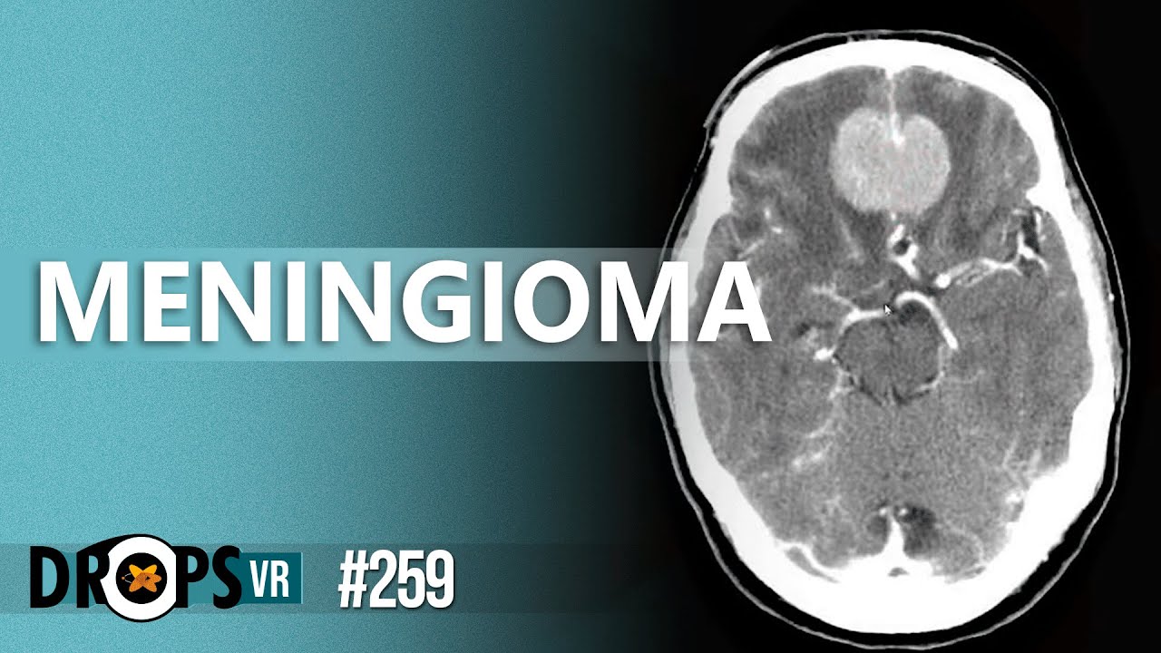 MENINGIOMA: ACHADOS DE IMAGEM NA TC E RM