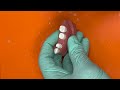 Adex Pfm Preparation Bridge Tooth 5
