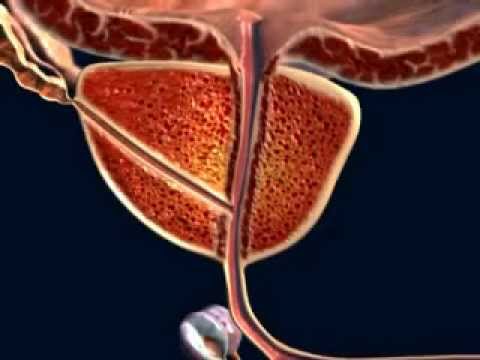 Massaggio prostatico post-operatorio La prognosi del cancro alla prostata con metastasi
