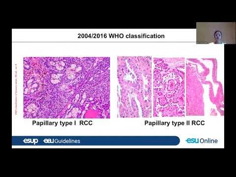 UROWebinar: WHO 2022 Classification of Male Genitourinary Tract tumor: What is relevant?