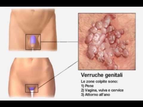 vindeca papilomul negilor crema clotrimazol pentru negi genitale