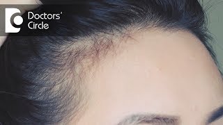 How to get rid of severe PCOS causing Hairfall? - Dr. Shefali Tyagi