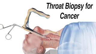 How a Throat Biopsy is Performed to Check for Thro
