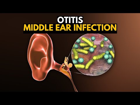 Middle Ear Infection (Otitis Media), Causes, SIgns and Symptoms, Diagnosis and Treatment.