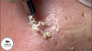 Muito Satisfatório | Remoção de cravos e espinhas