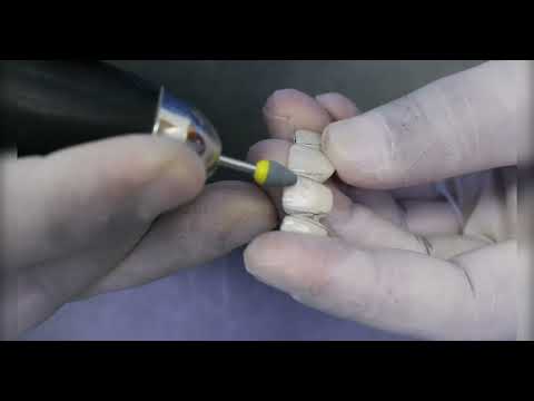 Zolid gen-x Multilayer Zircon bridge