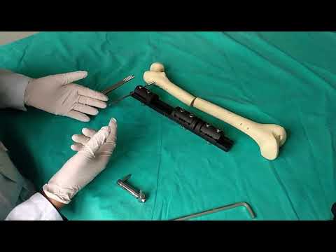 LRS Limb Lengthening External Fixator Surgical Technique