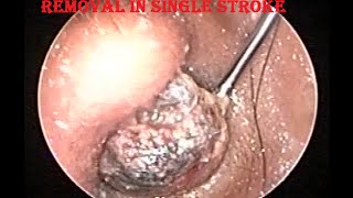 Hard Impacted Huge Ear Wax removal in one stroke