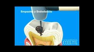Bucodente: Empaste y Endodoncia