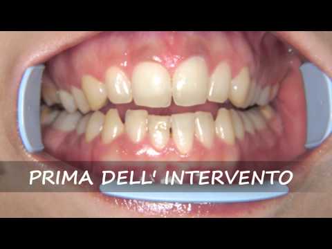 Dal quale i posti di pigmentary a uomini appaiono Le lentiggini di naso come liberarsi