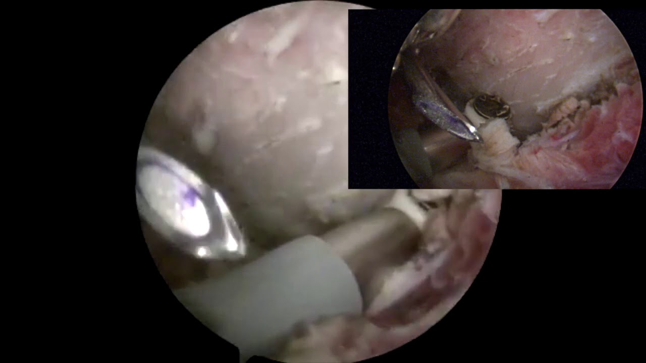 Dr. Garcia demonstrates his advanced arthroscopic technique for snapping scapula syndrome.