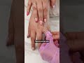 How To Remove A Ring From Swollen Finger