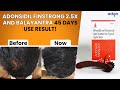 45 Days Hair Regrowth Story | Hair Loss | hair Fall | Bala Yantra | Adonsidil Finstrong 2.5 X | Adon