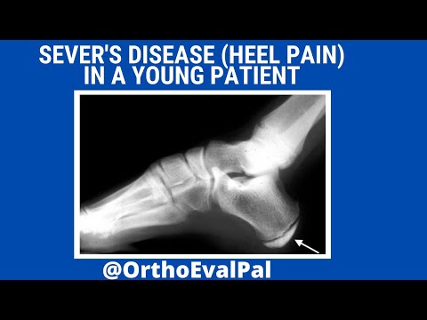 Metatarsalgia and Morton s Neuroma Evaluation and Treatment