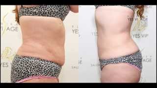 SlimLipo Laser Liposuction - Emilia