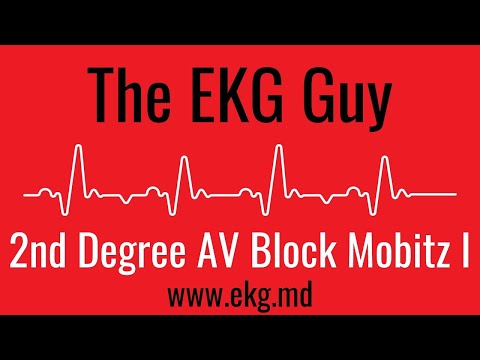 Second Degree AV Block Mobitz 1 (Wenckebach) EKG l The EKG Guy - www.ekg.md