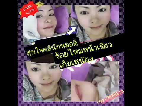 ร้อยไหม หน้าเรียว