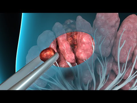 Breast Cancer | Breast Biopsy | Nucleus Health