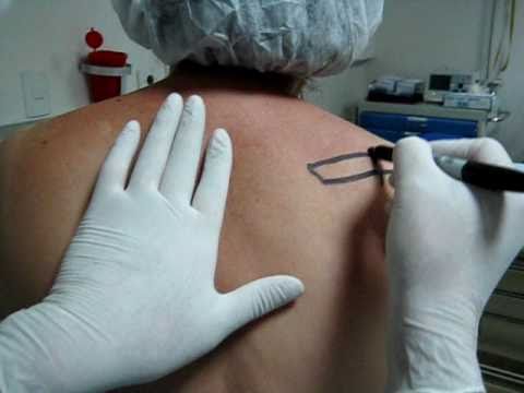 Dolor agudo en las palas del cuello y del hombro La osteocondrosis indicación