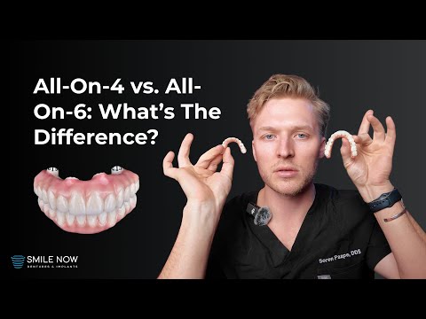 All On 4 vs All On 6 Dental Implants | Pros And Cons | Entire Process From Start To Finish