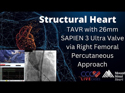 TAVR with 26mm SAPIEN 3 Ultra Valve via Right Femoral Percutaneous Approach