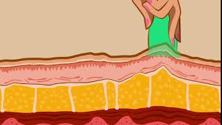How Cellulite Massage Cups Work On The Dermis