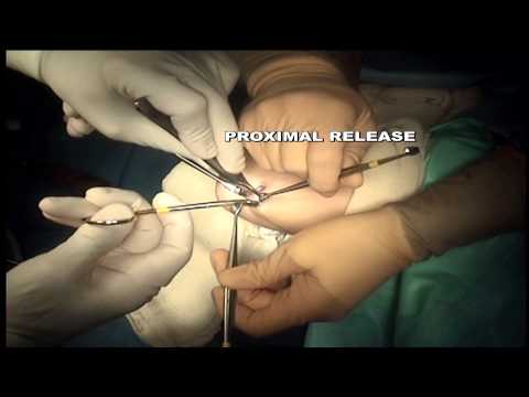 Endoscopic Cubital Tunnel Release Surgery