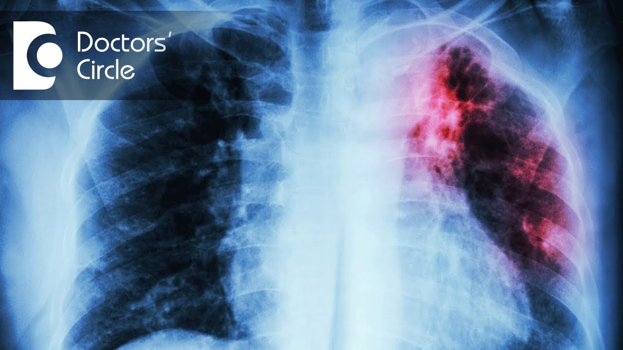 How long can you live with TB?