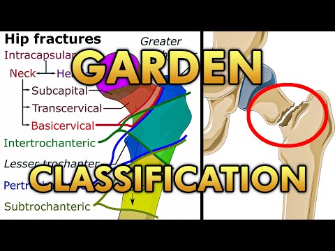 Garden Classification of Femur Neck Fractures