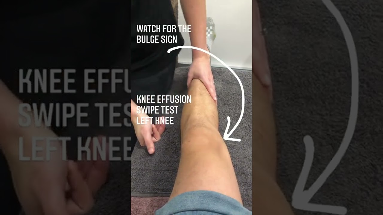 These videos show a positive “swipe test” or “stroke test” on both of these poor patients knees!