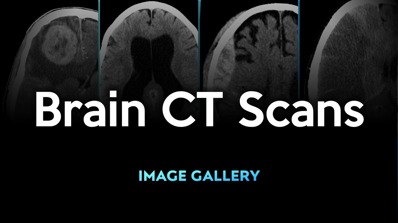 Brain CT Scans: Image Gallery