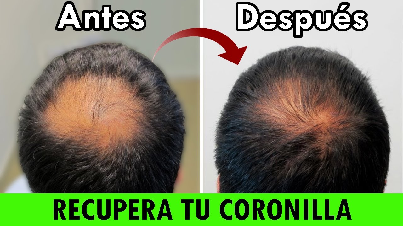 Watch CĂłmo Recuperar El Pelo De Tu Coronilla Sin Injerto Capilar Now CĂłmo Recuperar El Pelo De Tu Coronilla Sin Injerto Capilar