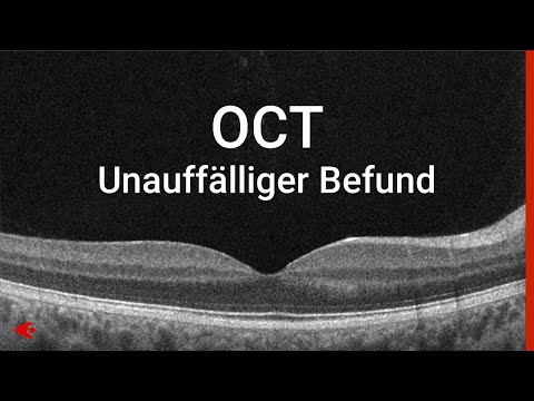 OCT - Unauffälliger Befund