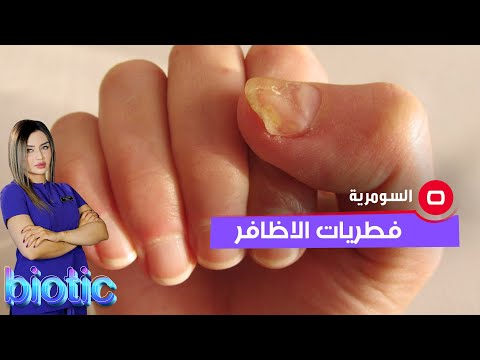 شاهد بالفيديو.. فطريات الاظافر واسبابها؟