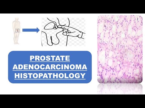 Bacterial prostatitis causes