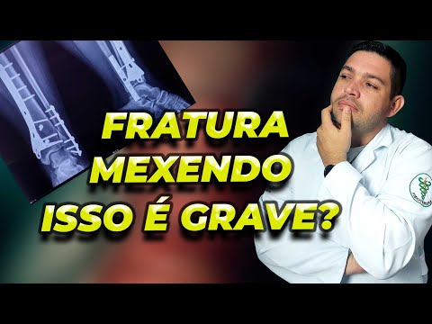 Sua FRATURA AINDA MEXE MESMO COM GESSO OU CIRURGIA?