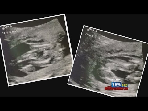 Fort Wayne family expecting conjoined twins